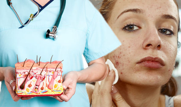 acne-treatments